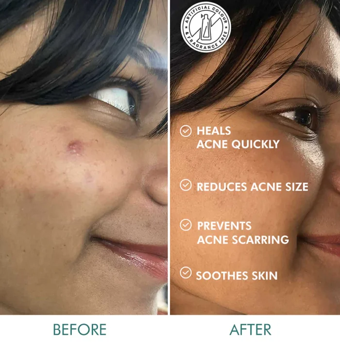 Matcha Tea Hydrocolloid Acne Patches with 0.5% Salicylic Acid | Reduces Acne in 2 Uses - 3 Sizes (24N) - Image 3